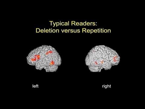 Cause and consequence in reading disability