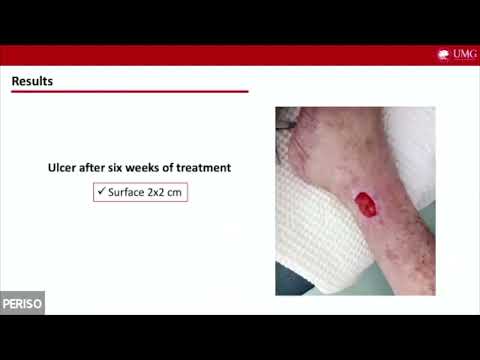 ICDT - Diamagnetotherapy in wound management - Roberta Roberti
