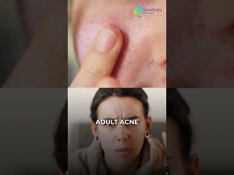 Effects of High Cortisol  #skinfinityderma #dermatologyclinic