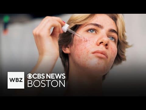 CBS Boston — "cortisol face may not actually be caused by..."