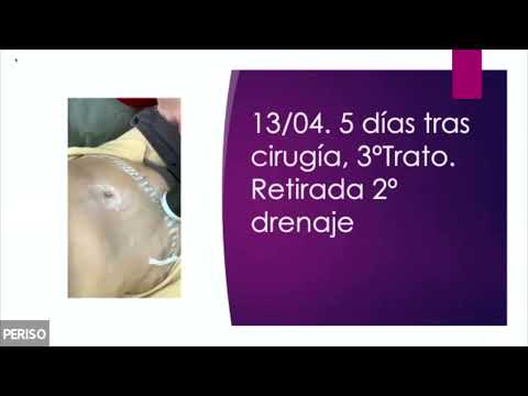 ICDT - Diamagnetotherapy in post-surgical hematoma-abdominoplasty - Iria Alfonso